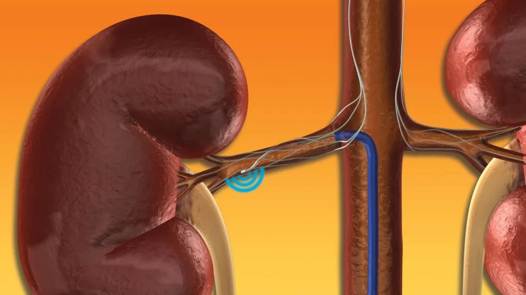 Nairobi West Hospital Performs Kenya’s First Renal Artery Denervation procedure